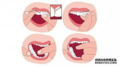 因为第二个和第三个齿从内到外向内倾