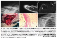 什么是锁骨窝脂肪？