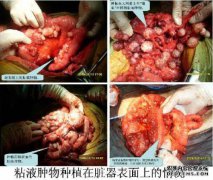 右中叶0.5 cm结节右对角下对角胸膜小m