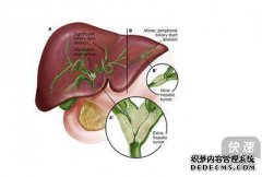 善治是哪种癌症？