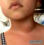 右颈手臂疼痛怎么办？颈部右侧有淋巴