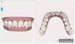 AB塑料的标识是否引起注意？口腔整形手