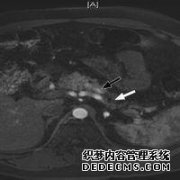 什么是胰管扩张？