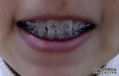 啮合一颗前牙时的校正方法