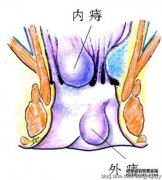 三七化瘀片治疗内q症的效果确实很明显