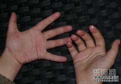 将手和脚浸入乙酸溶液中16天，溃疡会继