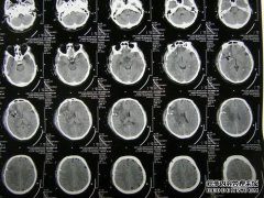 如何阅读cT脑图像