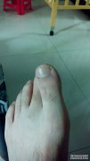 什么是脚趾疼痛？